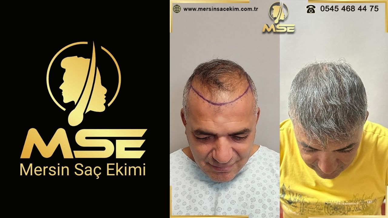 Mersin Saç Ekimi